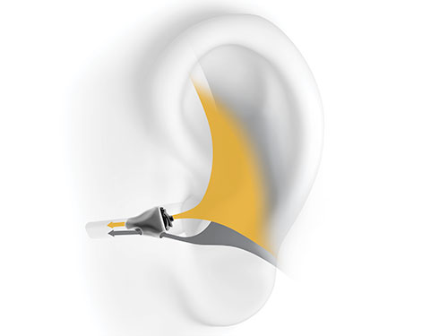 CIC-Hörgeräte sind so gut wie unsichtbar